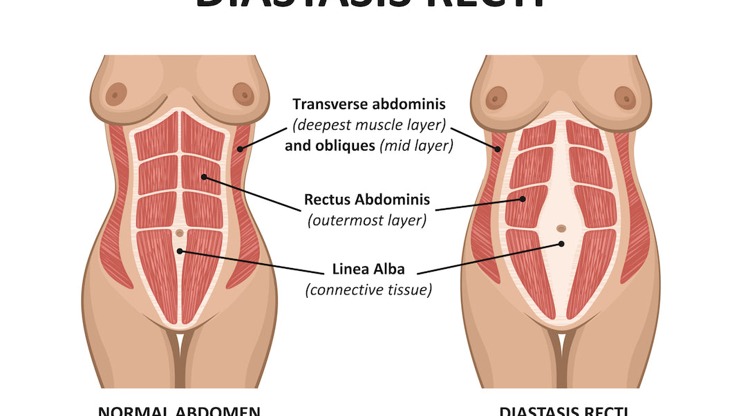 Five Exercises to Heal Diastasis Recti (DR)