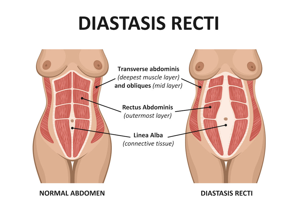 Five Exercises to Heal Diastasis Recti (DR)