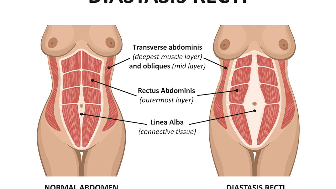 Five Exercises to Heal Diastasis Recti (DR)